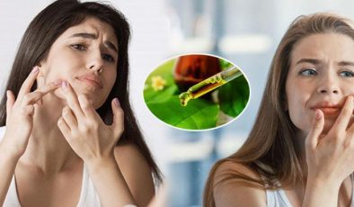 Cildinizi pamuk gibi yapıyor! Bir damlası sivilceleri yok etmek için yeterli